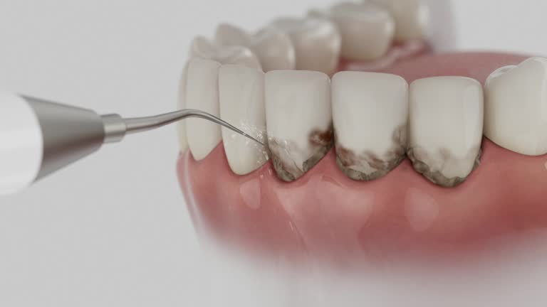 Trusted Wisdom Tooth Removal service in University Park, NM - Dentist Open Now